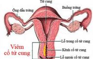 Điều trị viêm cổ tử cung ở nữ giới
