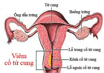 Điều trị viêm cổ tử cung ở nữ giới